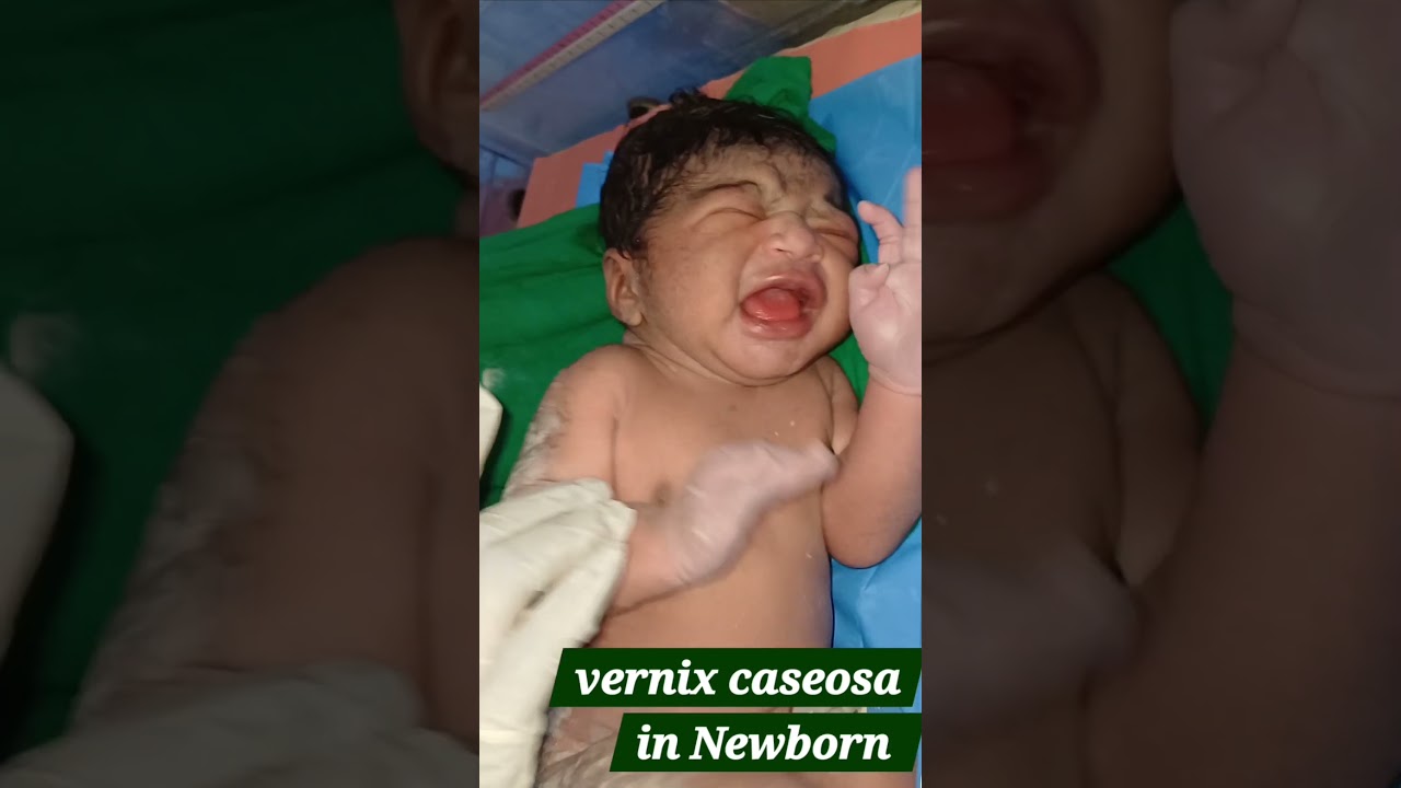 ||Vernix caseosa in Newborn ||#baby #ytshorts #shorts ||noellucky buddies channel ||