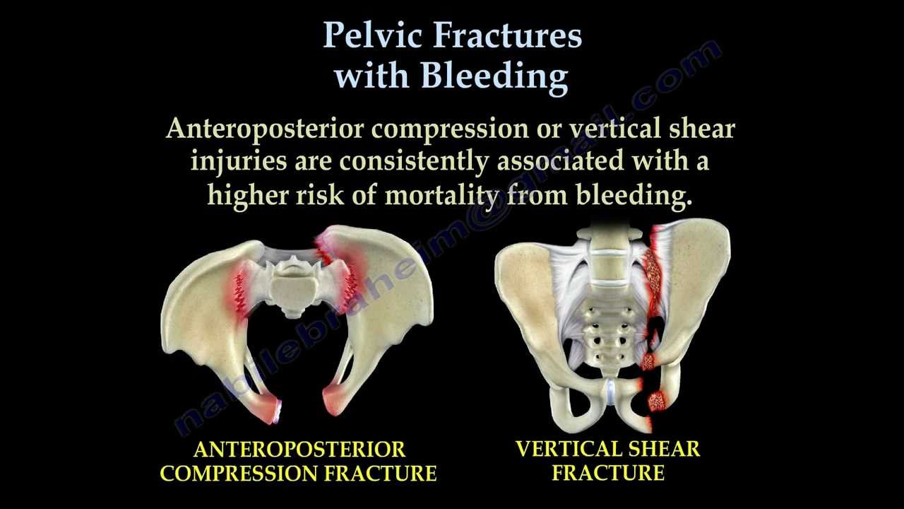 Pelvic Fractures With Bleeding - Everything You Need To Know - Dr. Nabil Ebraheim