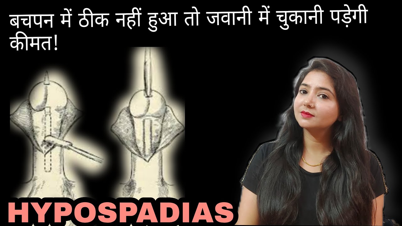 HYPOSPADIAS | बचपन में ठीक नहीं हुआ तो जवानी में चुकानी पड़ेगी कीमत |