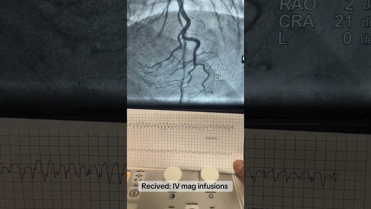 A unique lifesaving intervention: Acute MI with  TdP VT Storm! High-risk PCI & Overdrive Pacing! 