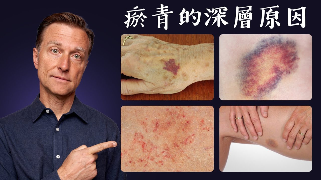 瘀青的深層原因，未受傷的瘀青，維生素K1K2自然療法,柏格醫生 Dr Berg