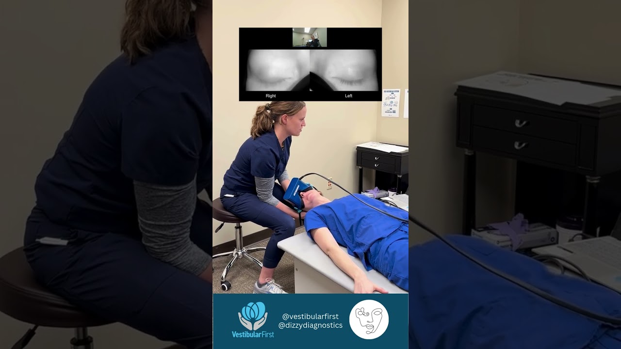Posterior canal BPPV nystagmus