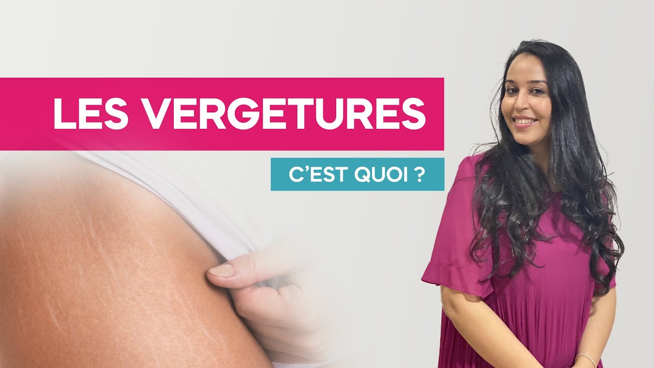 Dr. Hind HAIM : C'est quoi les vergetures ? - 1 Moment