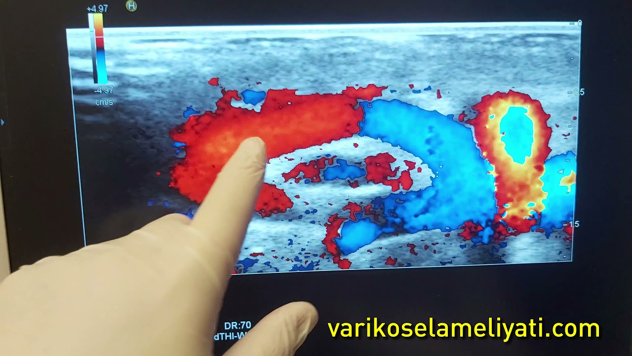 Testis Ağrısı ve Şişlik Belirtileri ile Varikosel Teşhisi: Mikrocerrahi Varikosel Ameliyatı Hazırlık