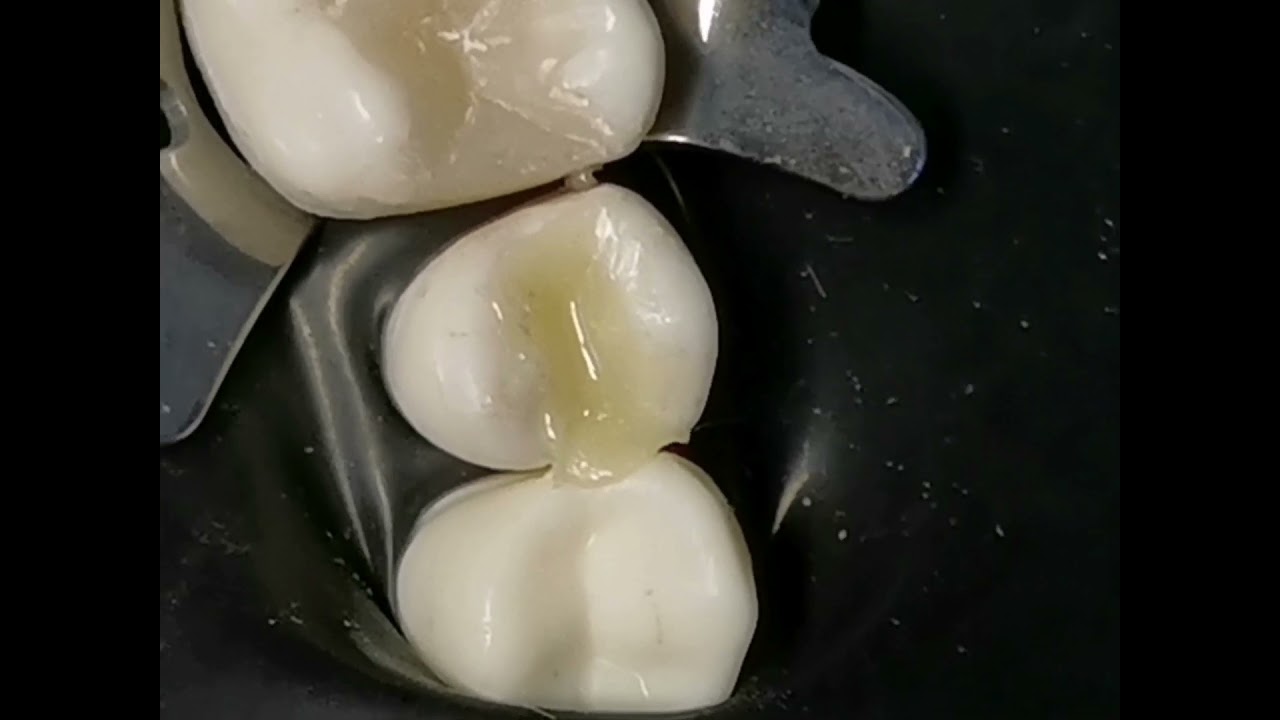 Composite restoration class 1 upper premolar