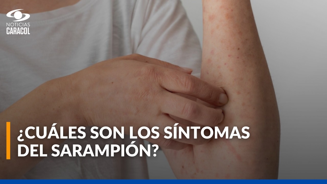 ¿Por qué es importante aplicarse la vacuna del sarampión? Síntomas de alerta