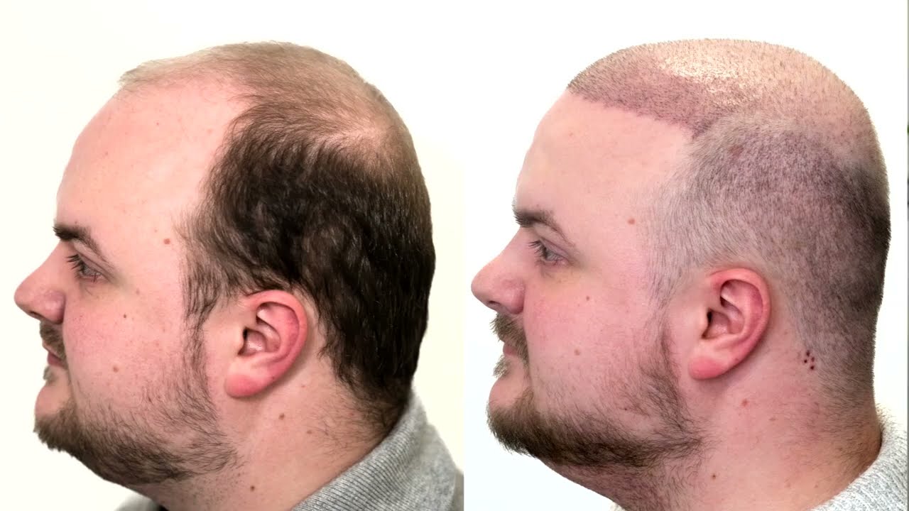 Adam's Hair transplant Experience with Este Medical Group