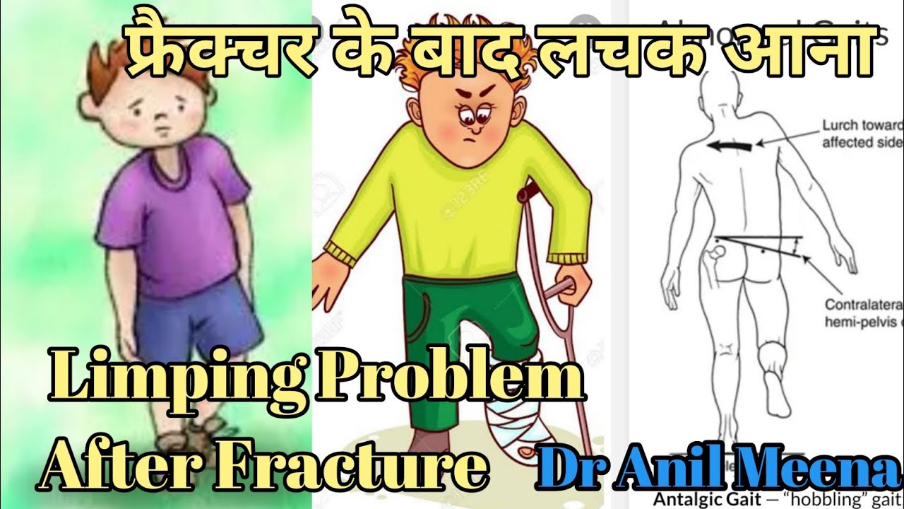 how to correct limping problem | limping correction exercises after Fracture | gait cycle | in hindi