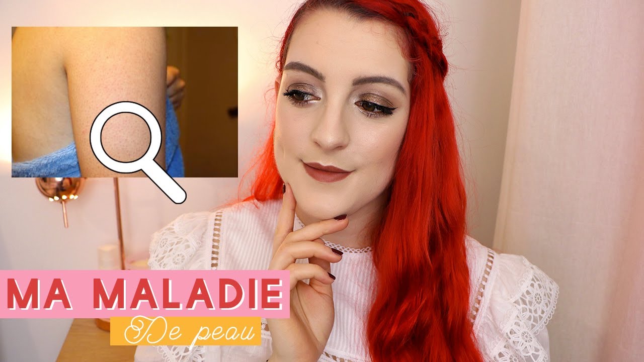 Ma maladie de peau : je vous dis tout 😫  Kératose Pilaire.. & mes conseils ! | LOdoesmakeup