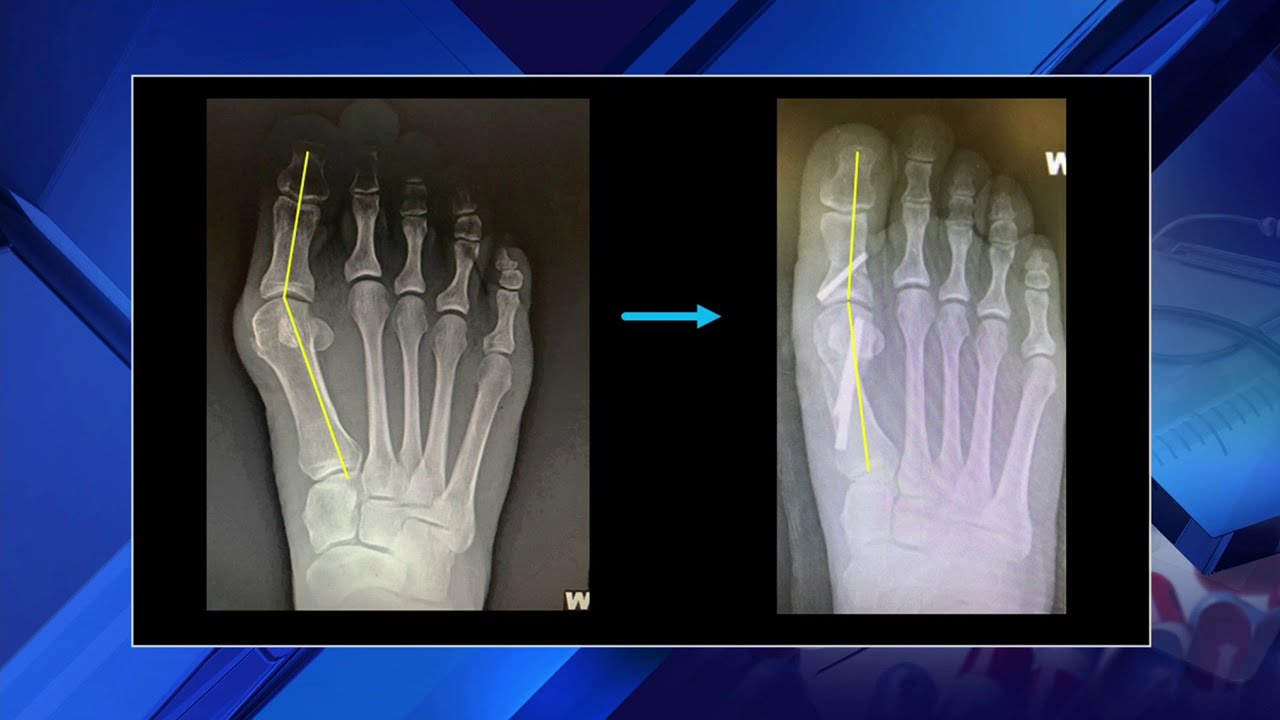 New minimally invasive bunion surgery