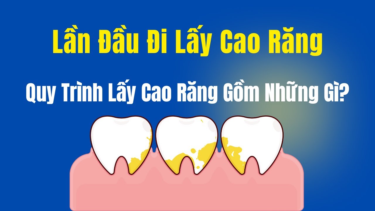 Lần Đầu Lấy Vôi Răng Cần Biết Gì? Quy Trình Lấy Cao Răng Tại Nha Khoa Gồm Các Bước Như Thế Nào