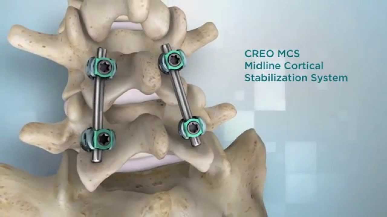 CREO MCS™ Stabilization System