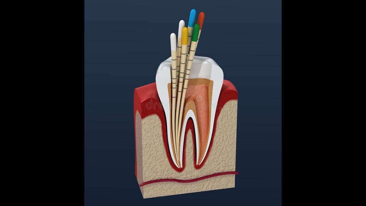 Tools for Overextended Gutta Percha