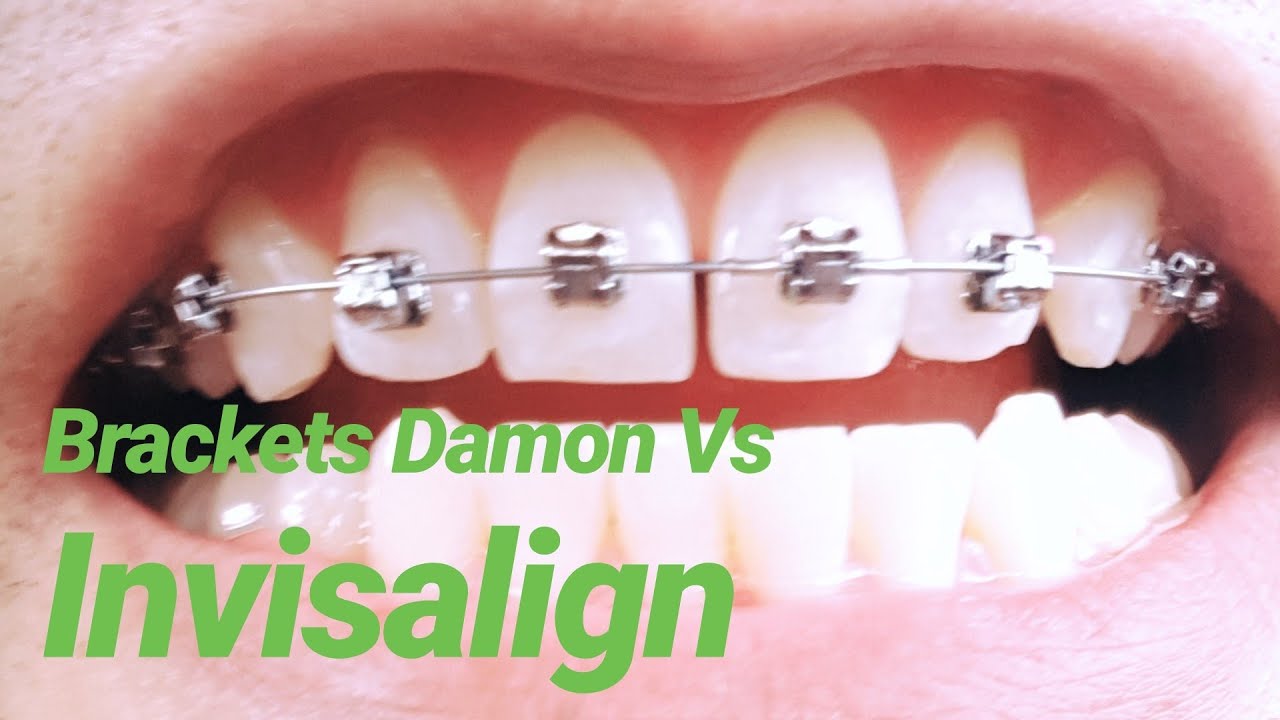 🔗🦷😬Brackets Nuevos tratamientos Damon vs Invisalign 2019