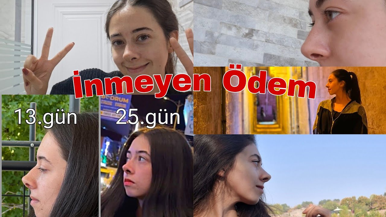 BURUN AMELİYATIM 1 AYLIK SÜREÇ | VLOG