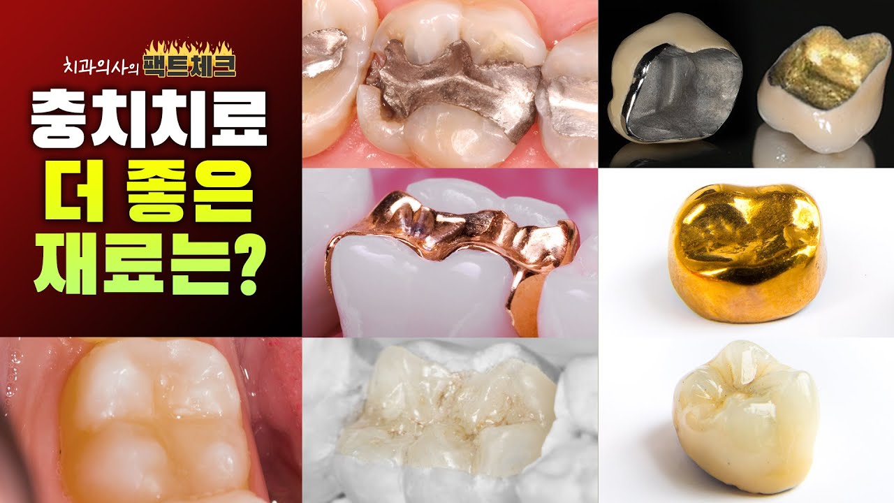 충치치료 받기 전, 재료 알고가세요! 👉레진, 인레이, 크라운, 아말감, GI, PFM, PFG