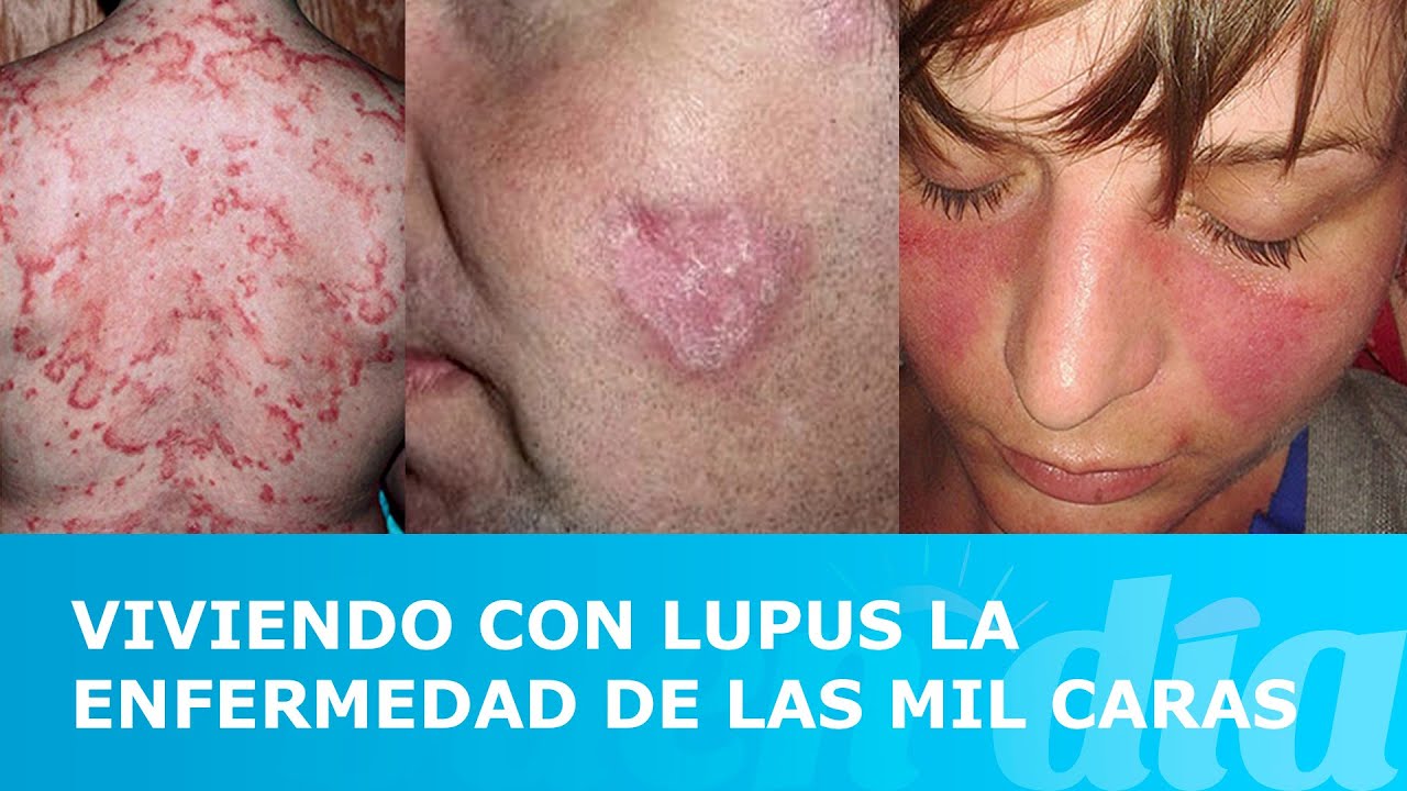Viviendo con lupus la enfermedad de las mil caras