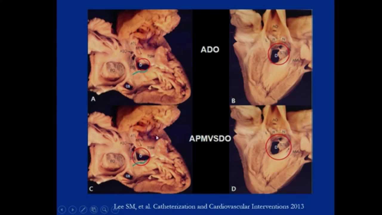 VSD / ASD/ AVSD