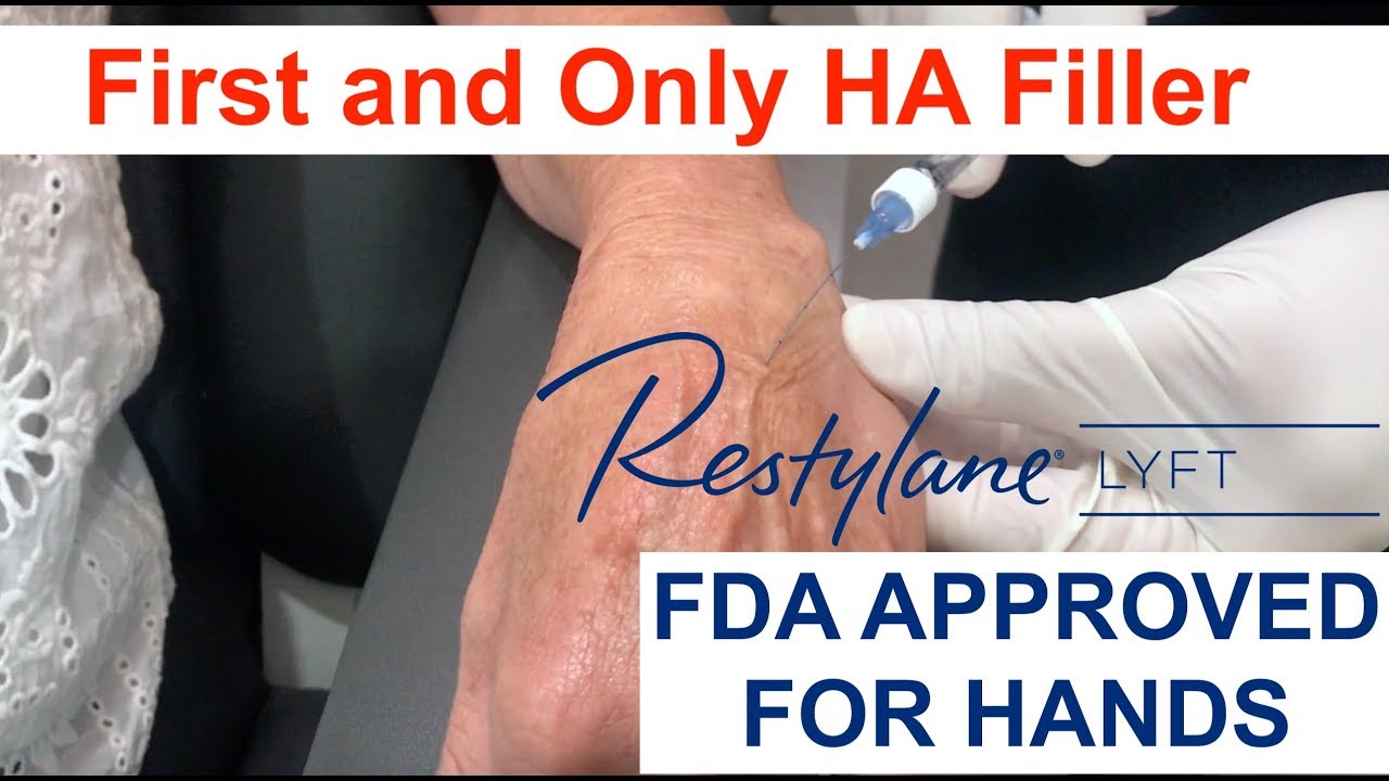 Restylane Lyft: First and Only Hyaluronic Acid filler to get FDA approval for Hands.