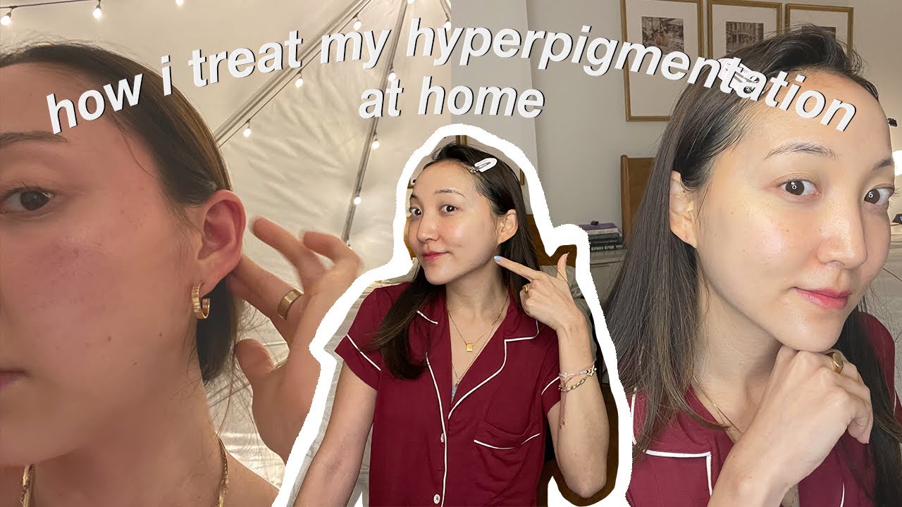How I Treat Hyperpigmentation at Home | morning routine