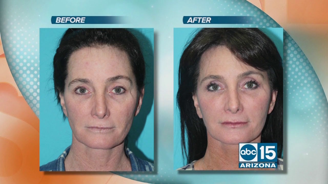 Wolin Plastic Surgery offers facial rejuvenation with natural looking results