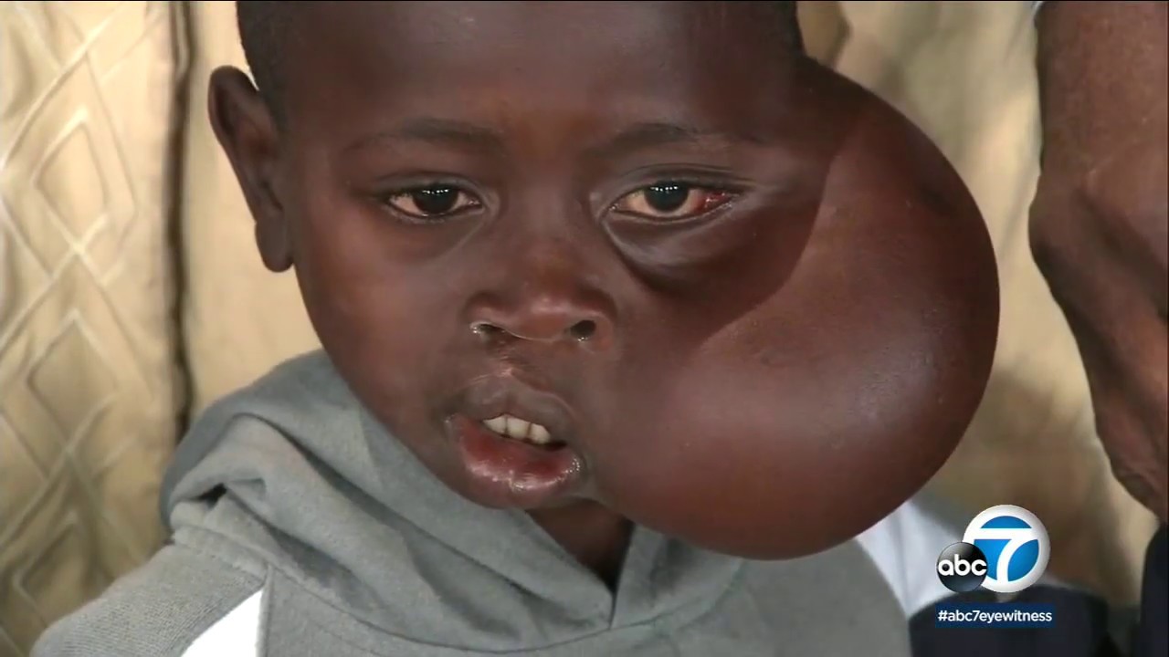 VIDEO: Retired NBA Star Dikembe Mutombo helps boy with tumor on face | ABC7