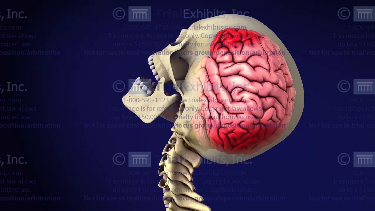 Coup-Contrecoup Injury Medical Exhibit