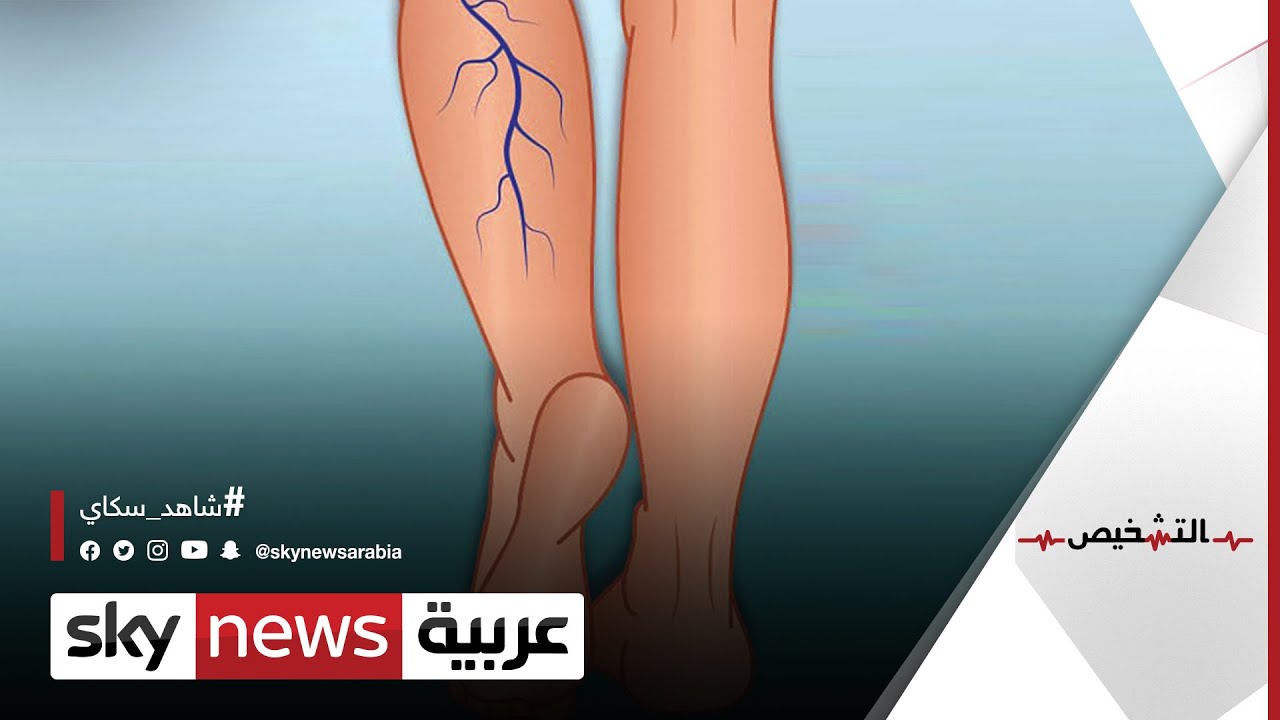 دوالي الساقين السطحية والعميقة وأسبابها الغامضة | #التشخيص