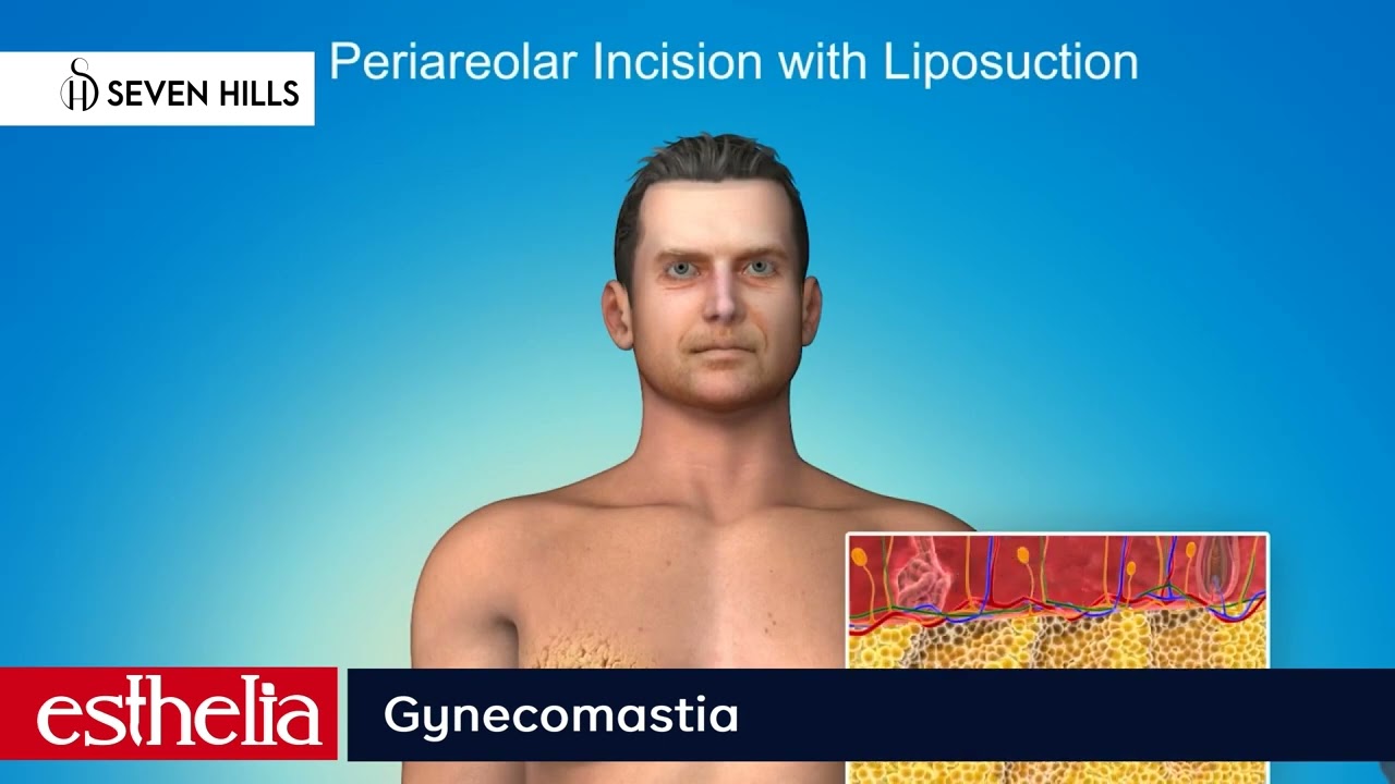 Gynecomastia