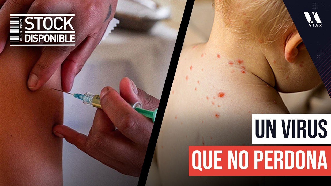 Caso de SARAMPIÓN en guagua NO VACUNADA enciende las alarmas en Chile