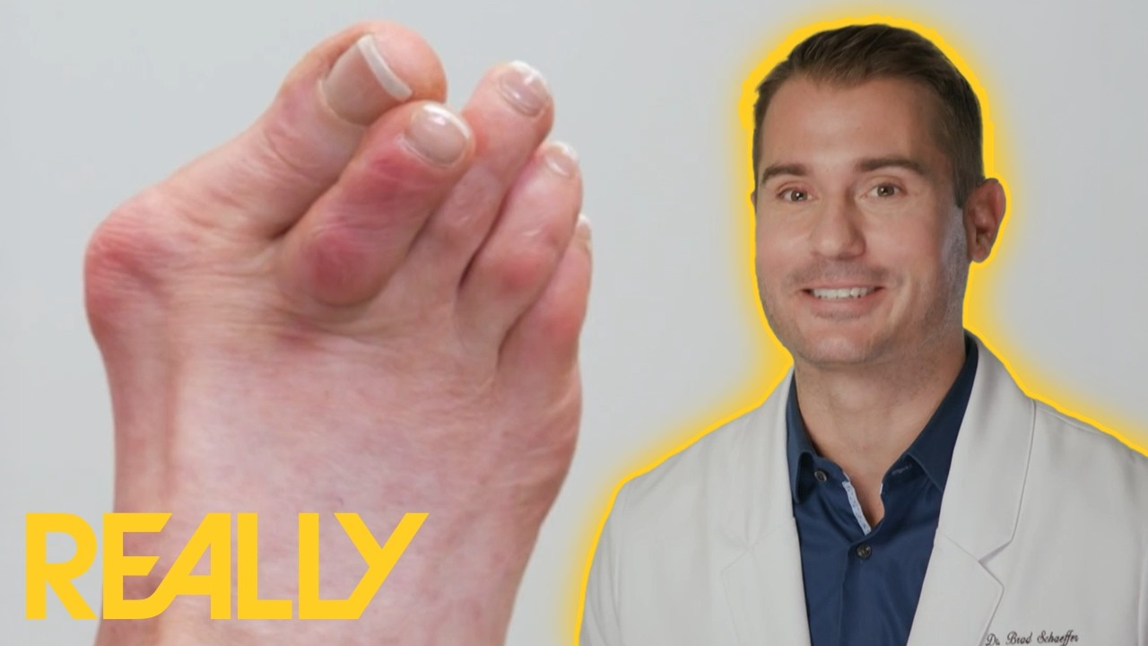 Dr. Brad Revisits The Worst Case Of Dancer&rsquo;s Feet He&rsquo;s Ever Seen | My Feet Are Killing Me