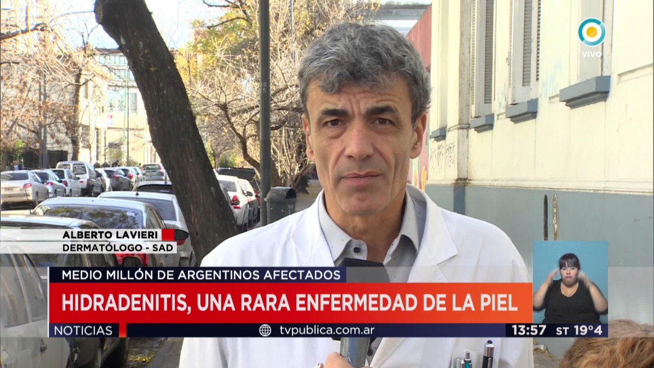 TV Pública Noticias - Hidradenitis, una rara enfermedad de la piel