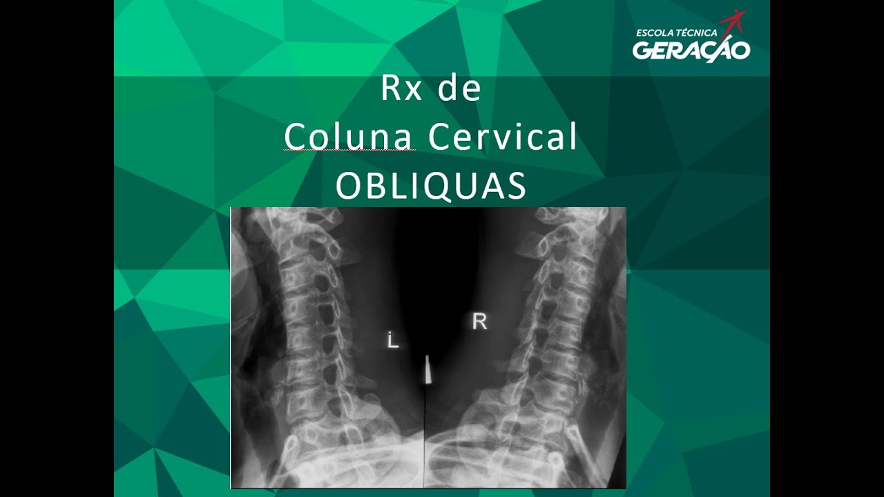 Radiografia da Coluna Cervical - Obliquas