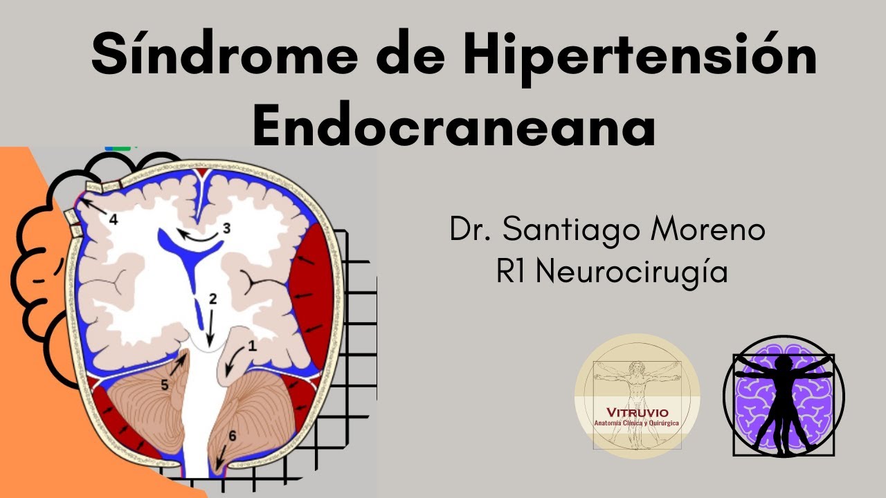 Síndrome Hipertensión Endocraneana | Dr Santiago Moreno García
