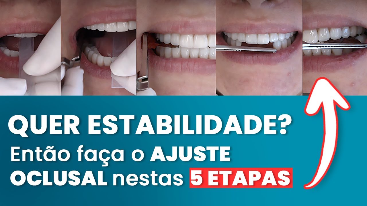 AS 5 ETAPAS DO AJUSTE OCLUSAL ESTÁVEL - Mylene e Renato