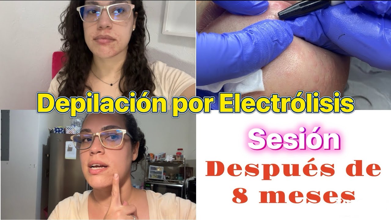 Depilación Por Electrólisis| Regreso #2