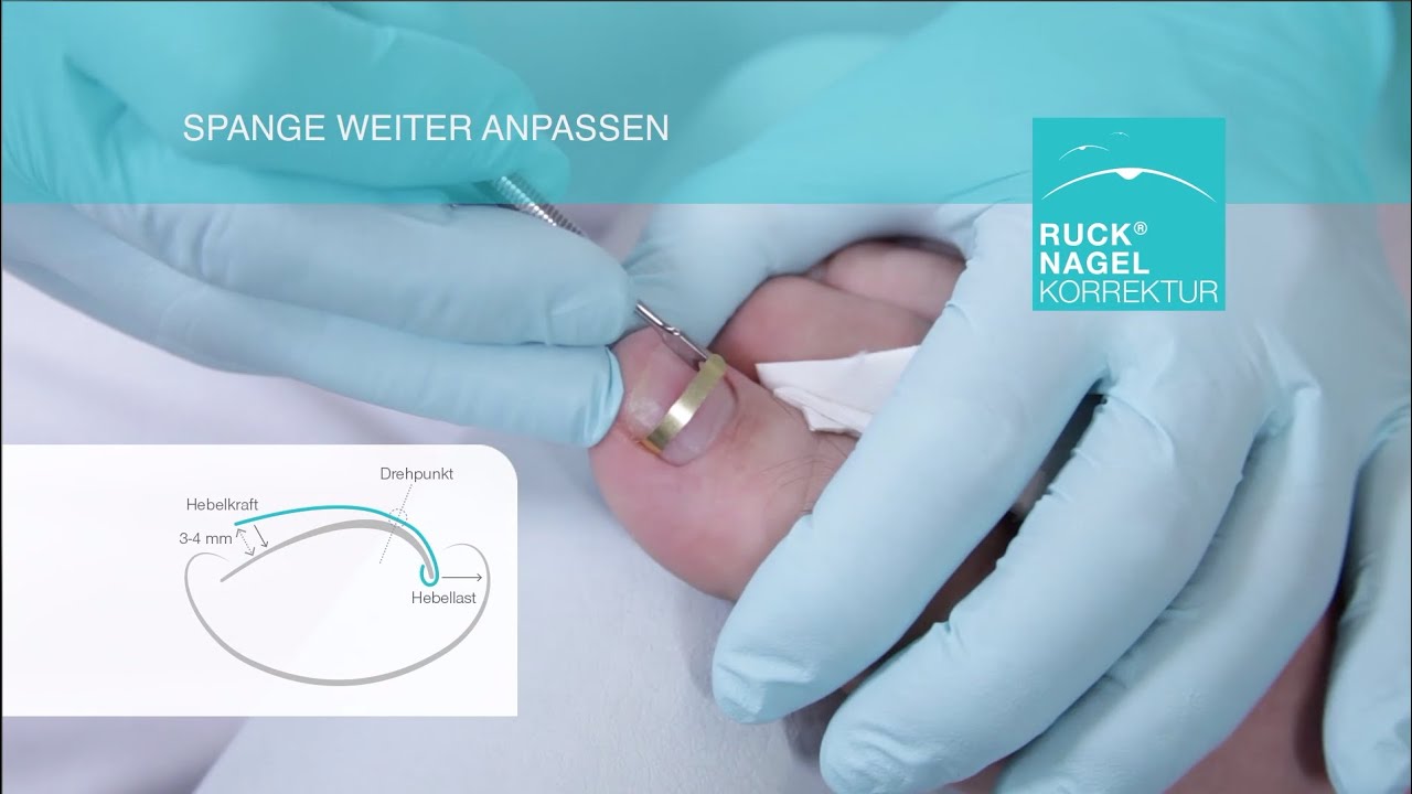 Hilfe für nahezu jeden Problemnagel - RUCK® NAGELKORREKTUR - GOLDSTADT professional (Halbspange)
