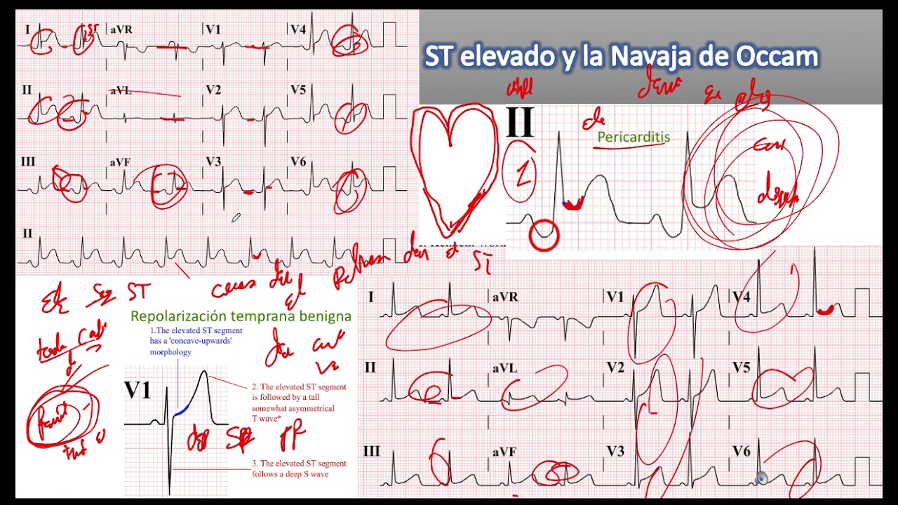 Pericarditis  EKG