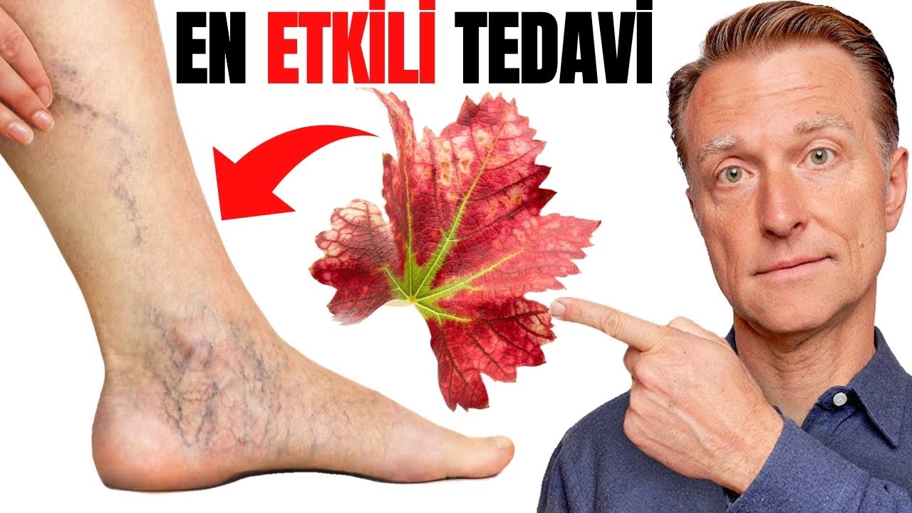 Etkili Varis Tedavisi: En İyi Y&ouml;ntem | Dr.Berg T&uuml;rk&ccedil;e
