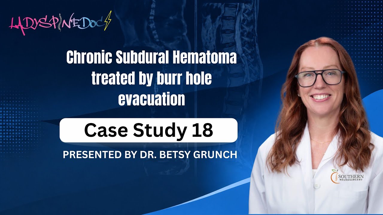 Case study 18 - Chronic Subdural Hematoma treated by burr hole evacuation EXPLAINED by  neurosurgeon