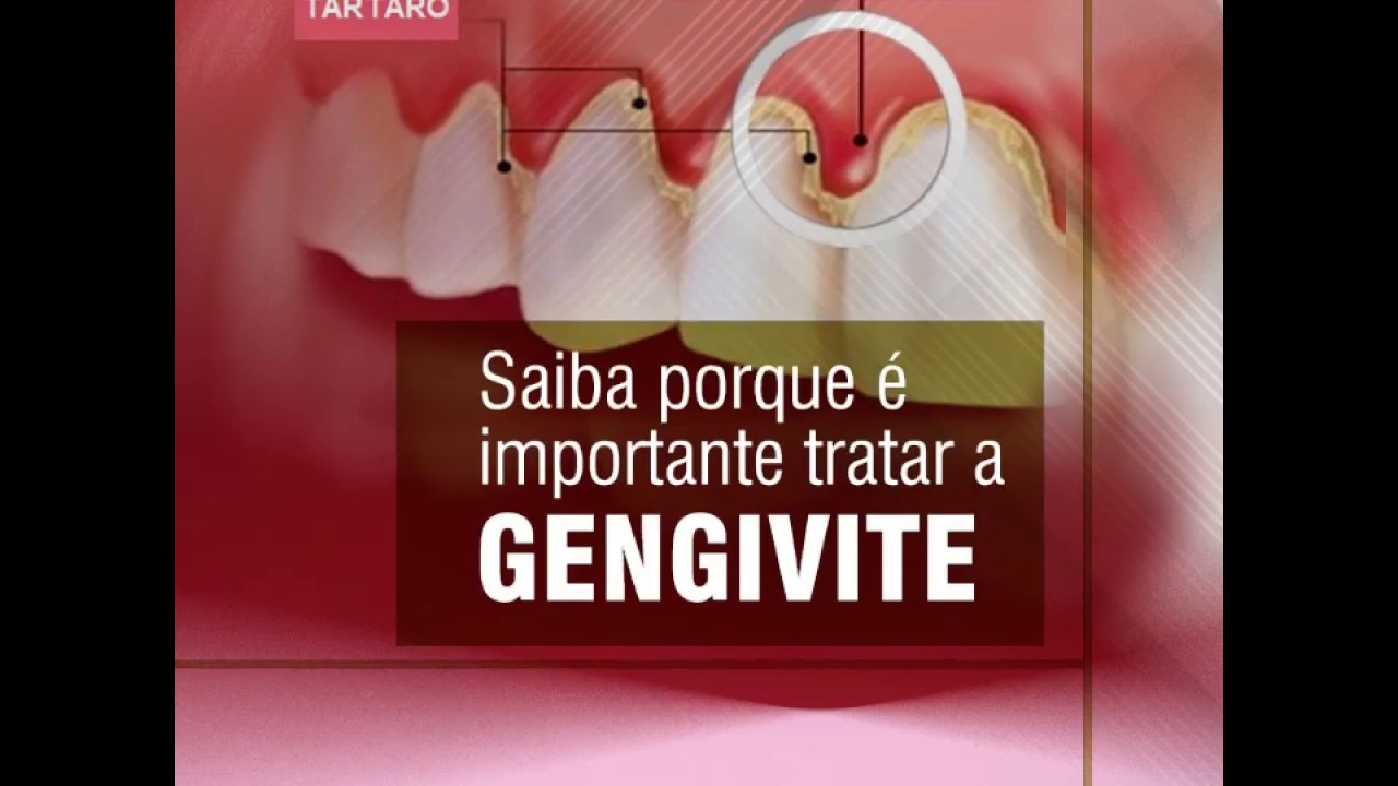 Saiba Porque &eacute; Importante tratar a Gengivite
