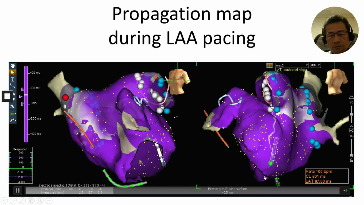 LAHRS2020 - 10NOV -  Cryoablation combined with vein of Marshall ethanol  The Yokohama experience