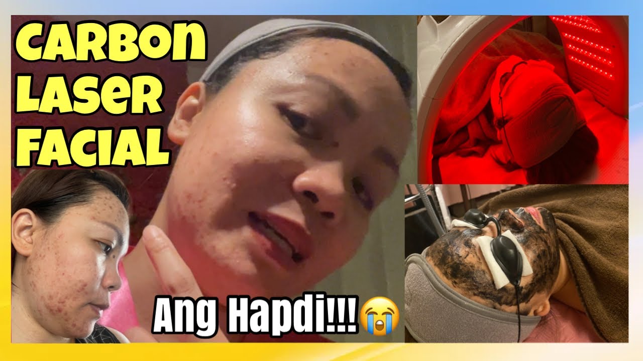 CARBON LASER TREATMENT | PANTANGGAL NG PIMPLES AT DARK SPOTS | TIIS GANDA PARA SA ROAD TO KINIS