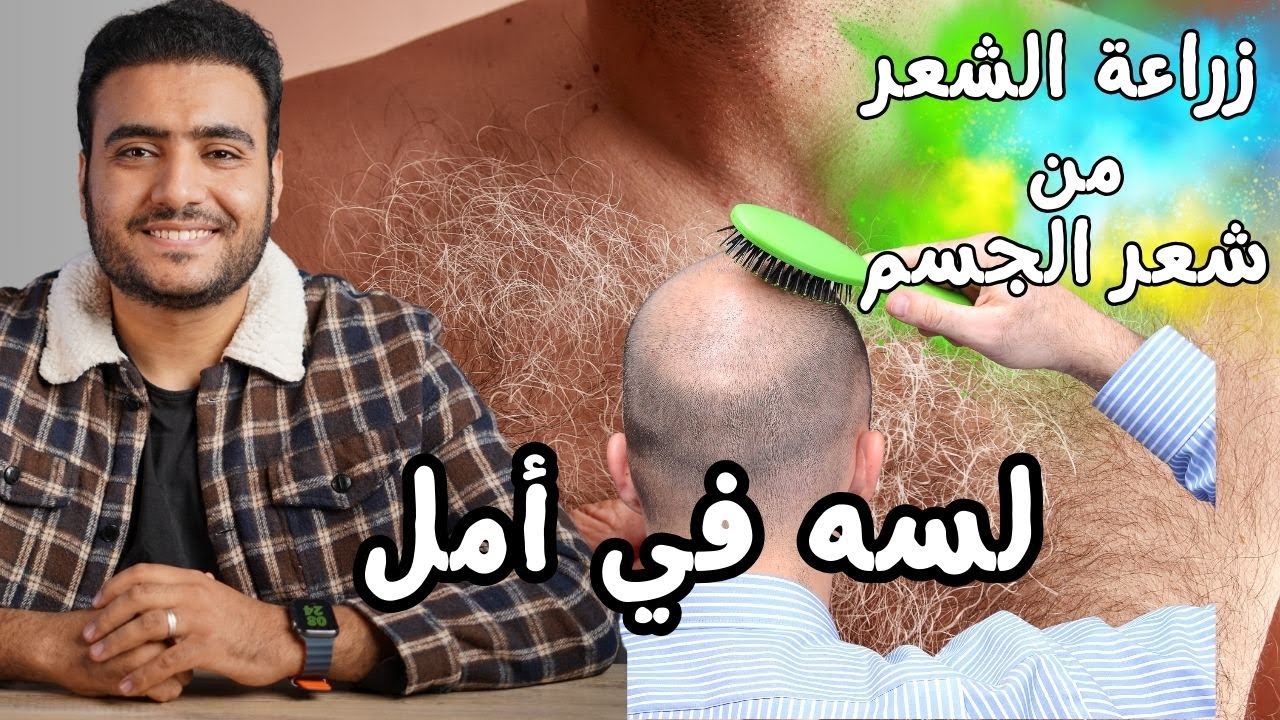 زراعة الشعر من شعر الجسم في حالة ضعف المنطقة المانحة I برنامج البسيط