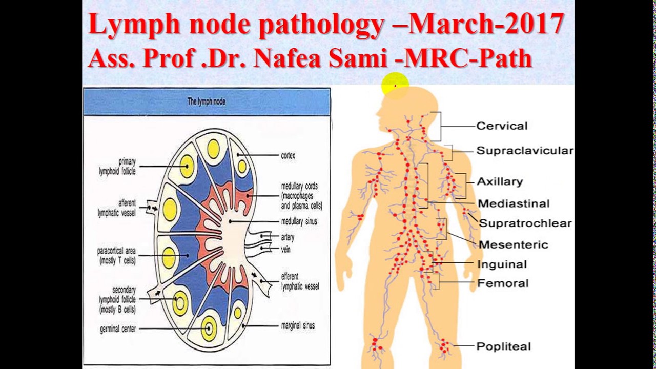 Pathology -- dr. Nafe'a -- Lymph Nodes Pathology أمراض الغدد الليمفاوية