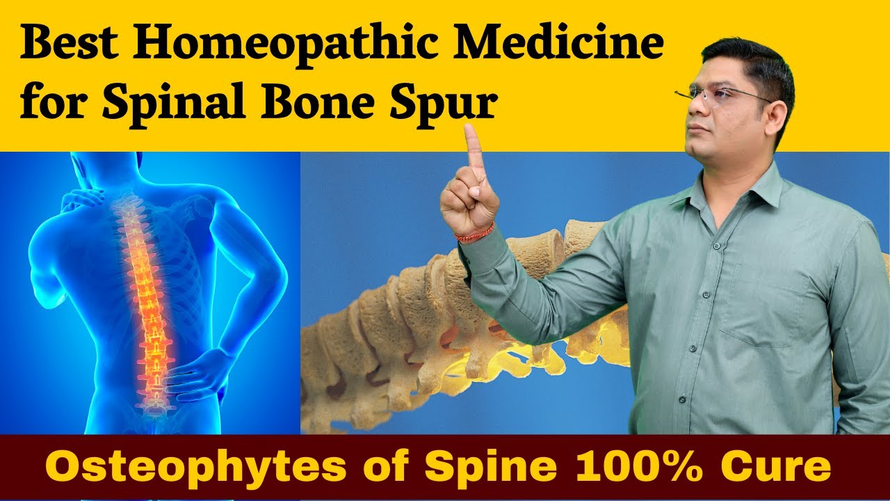 Best Homeopathic Medicine for Spinal Bone Spur Osteophytes of Spine 100% cure | Dr. Sunil Patidar