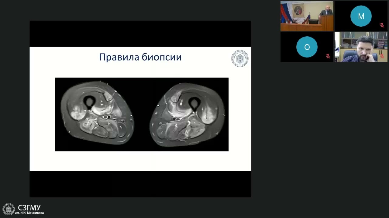 Миодистрофии и 
