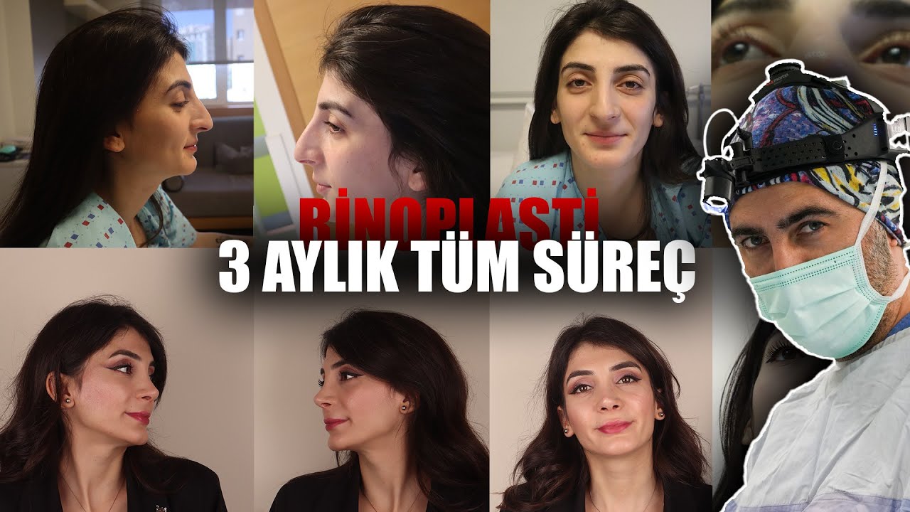 Rinoplasti Ameliyatı: 3 Aylık Süreç | Öncesi ve Sonrası Detaylı Anlatım