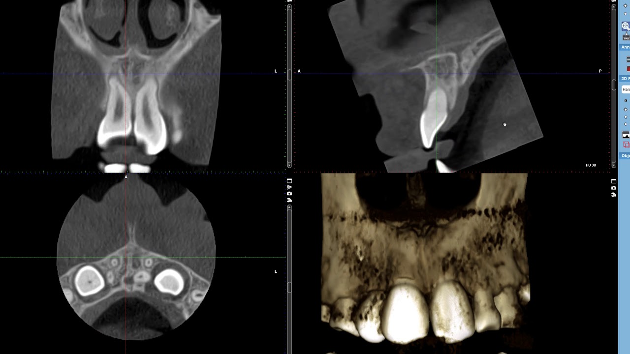 Impacted canines and lateral incisor in pano ceph CBCT