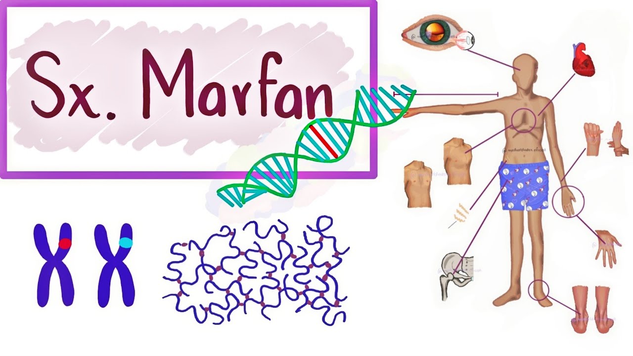 Síndrome de Marfan | Causas, Síntomas, Diagnóstico, Tratamiento